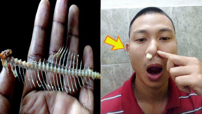 4 mẹo chữa hóc xương cá đơn giản hiệu nghiệm tức thì, bạn nên bỏ túi phòng khi cần